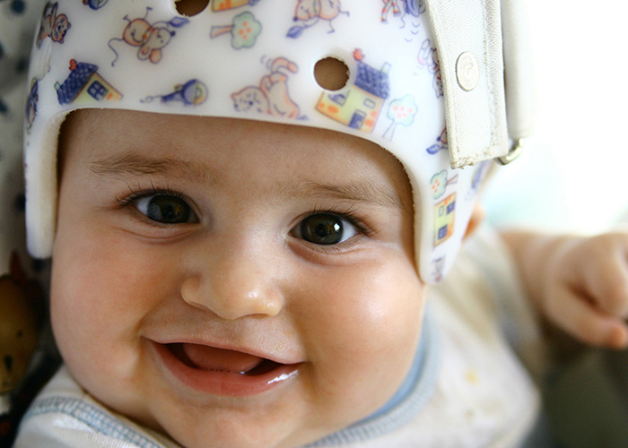 baby wearing a cranial helmet